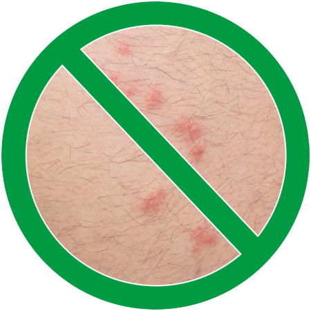 Image of flea bites on human skin in green circle slash icon; Northern Pest treats and prevents fleas.